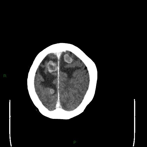 Cerebral metastases - breast primary (Radiopaedia 77653-89857 Axial C+ delayed 99).jpg