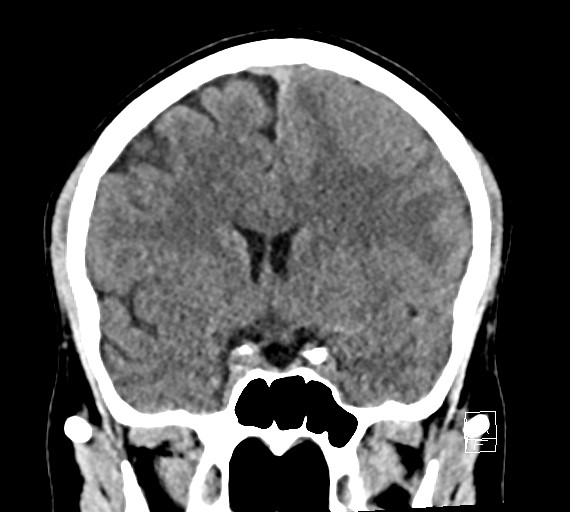 Cerebral metastases - testicular choriocarcinoma (Radiopaedia 84486-99855 Coronal C+ delayed 27).jpg