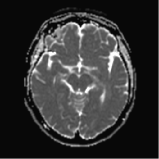File:Cerebral metastases mimicking abscesses (Radiopaedia 45841-50131 Axial ADC 13).png