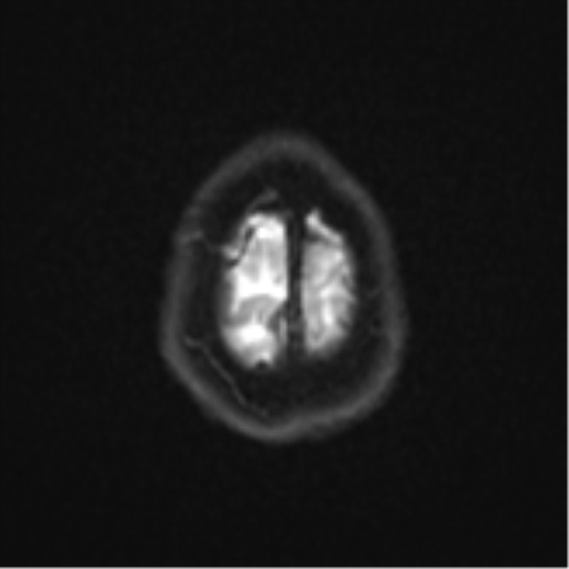 Cerebral metastases mimicking abscesses (Radiopaedia 45841-50131 Axial DWI 27).png