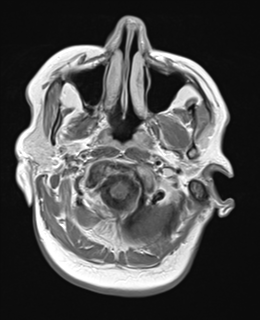 File:Cerebral metastases mimicking abscesses (Radiopaedia 45841-50131 Axial T1 C+ fat sat 3).png