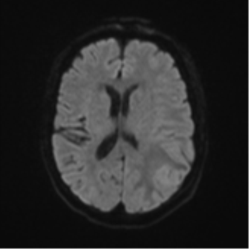 Cerebral metastasis (Radiopaedia 46744-51248 Axial DWI 44).png