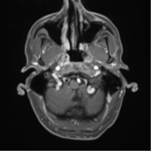 Cerebral metastasis - melanoma (Radiopaedia 54718-60954 Axial T1 C+ fat sat 8).png