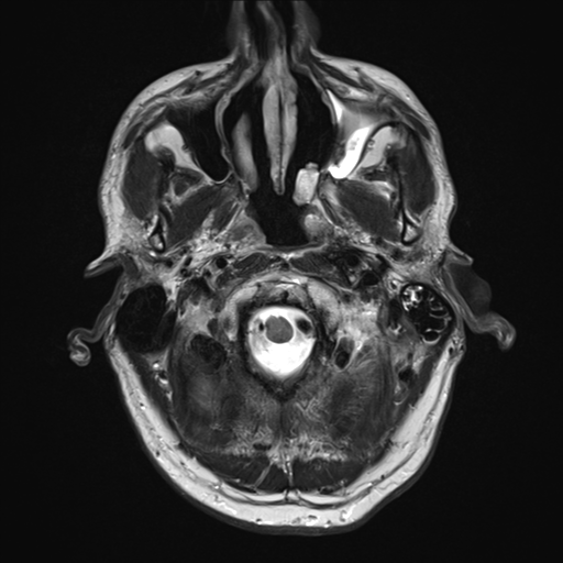 File:Cerebral metastasis - melanoma (Radiopaedia 54718-60954 Axial T2 3).png