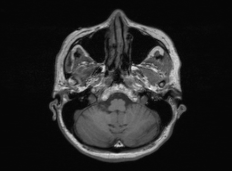 Cerebral ring enhancing lesions - cerebral metastases (Radiopaedia 44922-48817 Axial T1 321).jpg