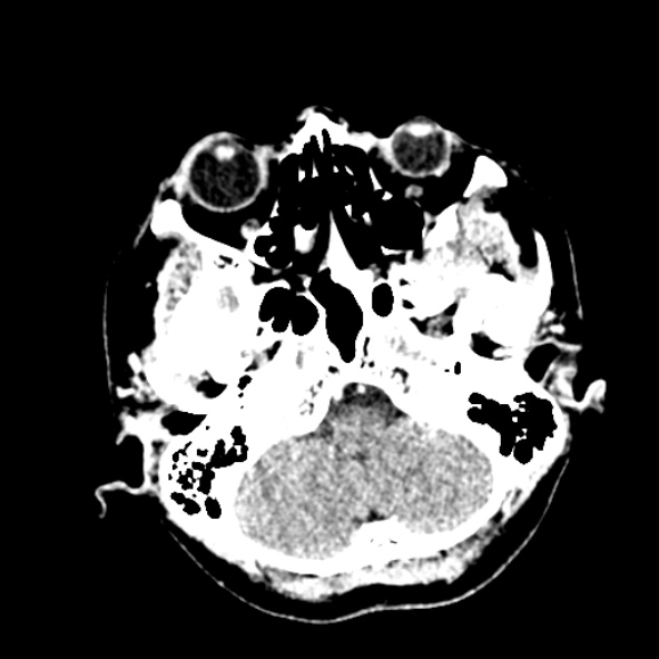 File:Cerebral ring enhancing lesions - cerebral metastases (Radiopaedia 44922-48818 B 51).jpg