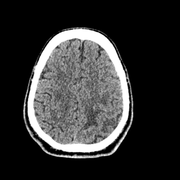 Cerebral toxoplasmosis (Radiopaedia 53993-60131 Axial non-contrast 62).jpg