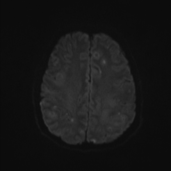 Cerebral toxoplasmosis (Radiopaedia 53993-60132 Axial DWI 46).jpg