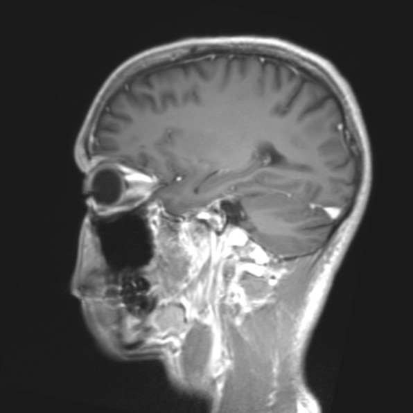 File:Cerebral toxoplasmosis (Radiopaedia 53993-61435 Coronal T1 23).jpg