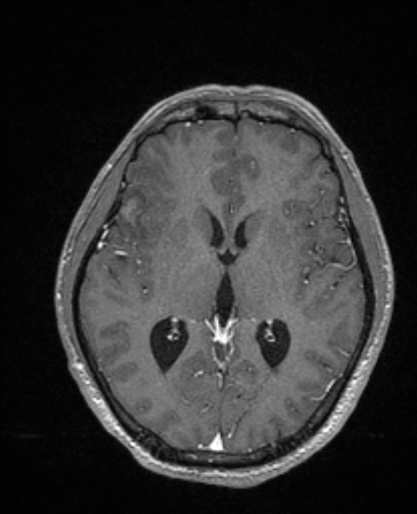 Cerebral toxoplasmosis (Radiopaedia 85779-101597 Axial T1 C+ 85).jpg