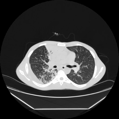 Cerebral tuberculoma (Radiopaedia 80829-94318 Axial lung window 76).jpg