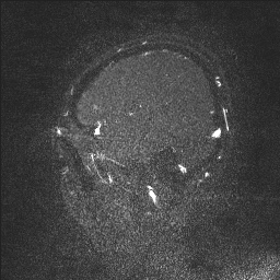 Cerebral tuberculosis with dural sinus invasion (Radiopaedia 60353-68090 Sagittal MRV 18).jpg
