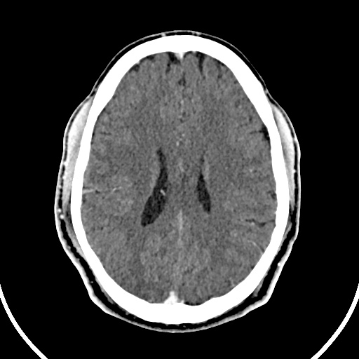 Cerebral venous angioma (Radiopaedia 69959-79977 B 62).jpg