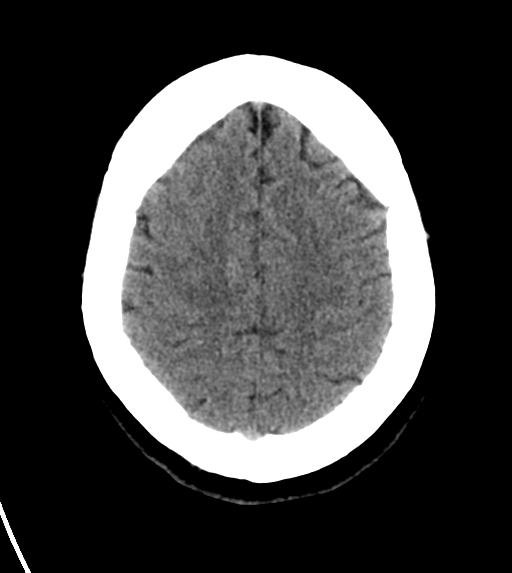 File:Cerebral venous infarct related to dural venous sinus thromboses (Radiopaedia 35292-36804 Axial non-contrast 23).png
