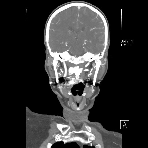 Cerebral venous infarction with hemorrhage (Radiopaedia 65343-74396 B 164).jpg