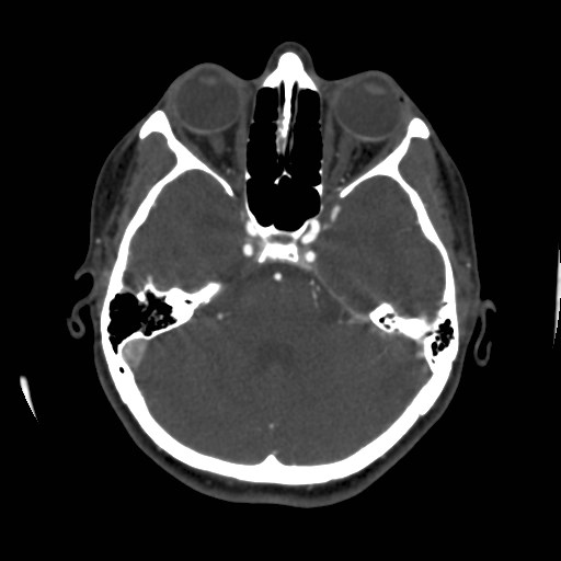 Cerebral venous sinus thrombosis (Radiopaedia 40619-43227 A 68).jpg