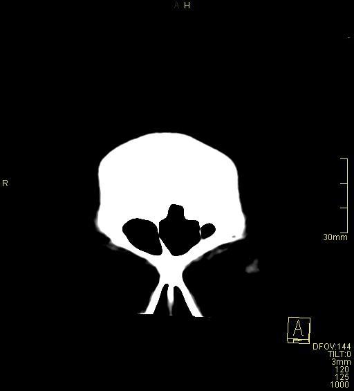Cerebral venous sinus thrombosis (Radiopaedia 91329-108965 Coronal non-contrast 3).jpg