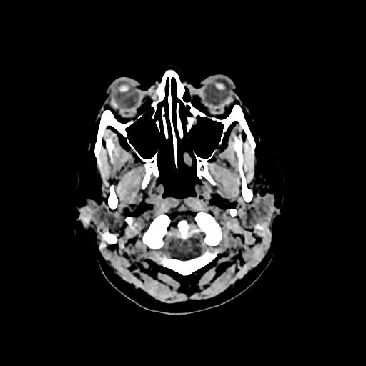 Cerebral venous throbmosis - hemorrhagic venous infarction (Radiopaedia 87318-103613 Axial non-contrast 4).jpg