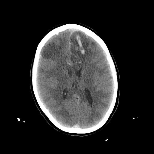 Cerebral venous throbmosis - hemorrhagic venous infarction (Radiopaedia 87318-103613 Axial non-contrast 97).jpg