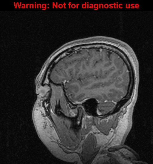 Cerebral venous thrombosis (Radiopaedia 37224-39208 Sagittal T1 C+ 30).jpg