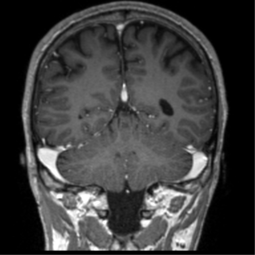 Cerebral venous thrombosis (Radiopaedia 38392-40469 Coronal T1 C+ 27).png