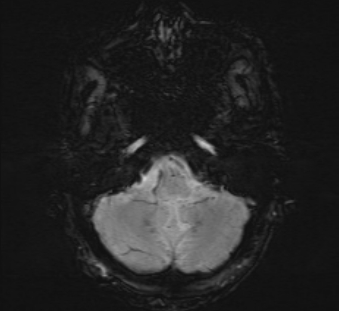 Cerebral venous thrombosis (Radiopaedia 71207-81504 Axial SWI 7).jpg