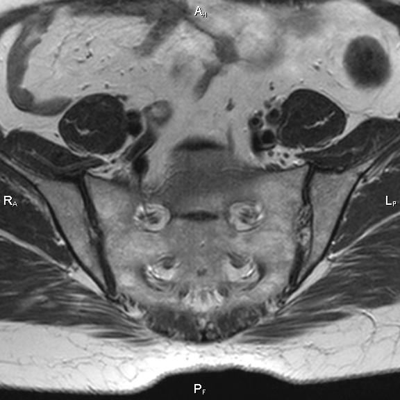 File:Cervical adenocarcinoma (Radiopaedia 65011-73985 Axial T2 35).jpg