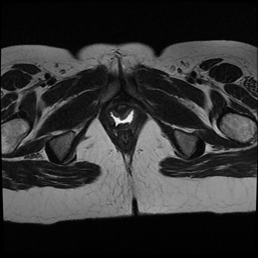 File:Cervical cancer (Radiopaedia 62991-71413 Axial T2 19).jpg