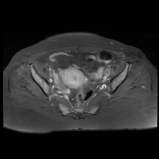 File:Cervical carcinoma (Radiopaedia 88010-104555 Axial T1 C+ fat sat 9).jpg