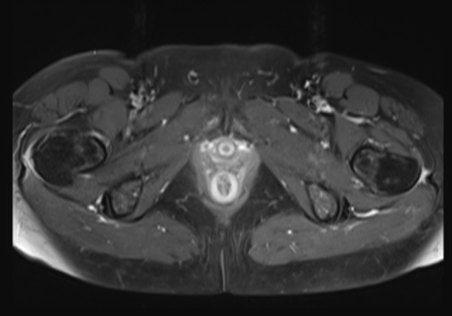 File:Cervical carcinoma (Radiopaedia 88312-104943 Axial T1 C+ fat sat 19).jpg