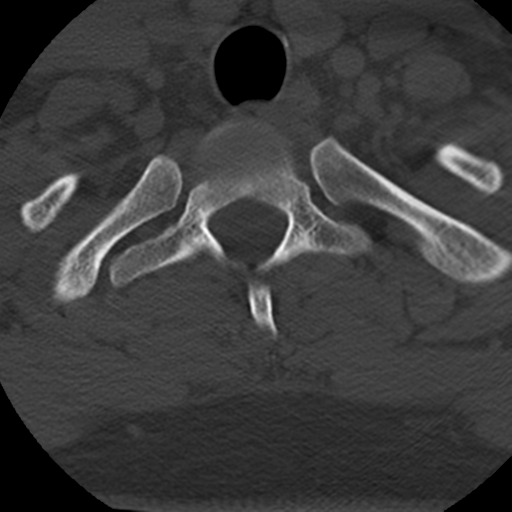 File:Cervical schwannoma (Radiopaedia 57979-64974 Axial bone window 44).png