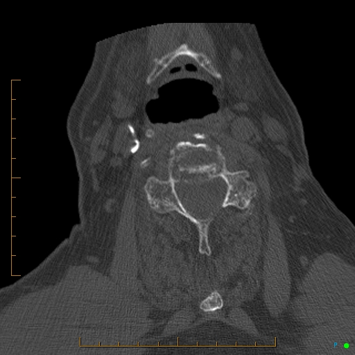 File:Cervical spine fracture - ankylosing spondylitis (Radiopaedia 76835-88706 Axial bone window 122).jpg