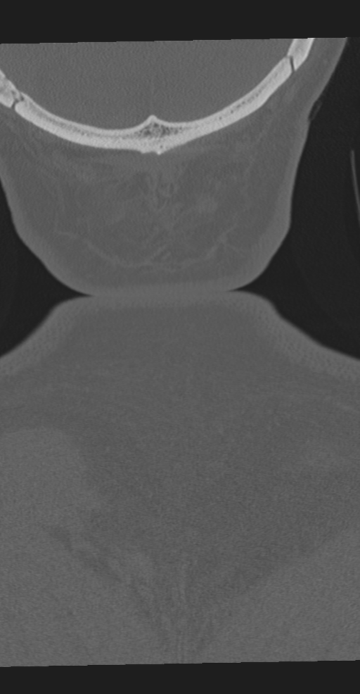 Cervical spine fracture in the setting of ankylosis (Radiopaedia 37038-38715 Coronal bone window 78).png