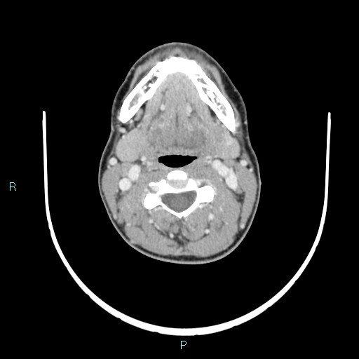 Cervical thymic cyst (Radiopaedia 88632-105335 C 73).jpg
