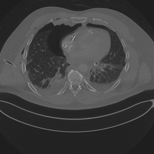 Chest multitrauma - aortic injury (Radiopaedia 34708-36147 Axial bone window 186).png