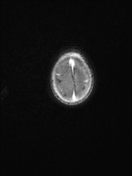 Chiari III malformation with occipital encephalocele (Radiopaedia 79446-92559 Axial T1 C+ mpr 76).jpg