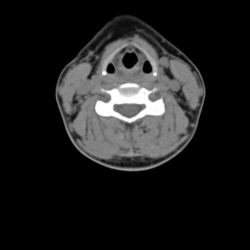 Chiari I malformation and obstructive hydrocephalus (Radiopaedia 41185-43981 D 56).png