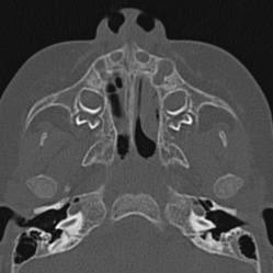 Choanal atresia (Radiopaedia 88525-105975 Axial bone window 21).jpg