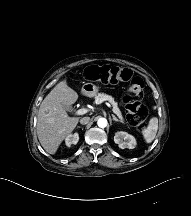 Cholangiocarcinoma with cerebral metastases (Radiopaedia 83519-98629 B 27).jpg