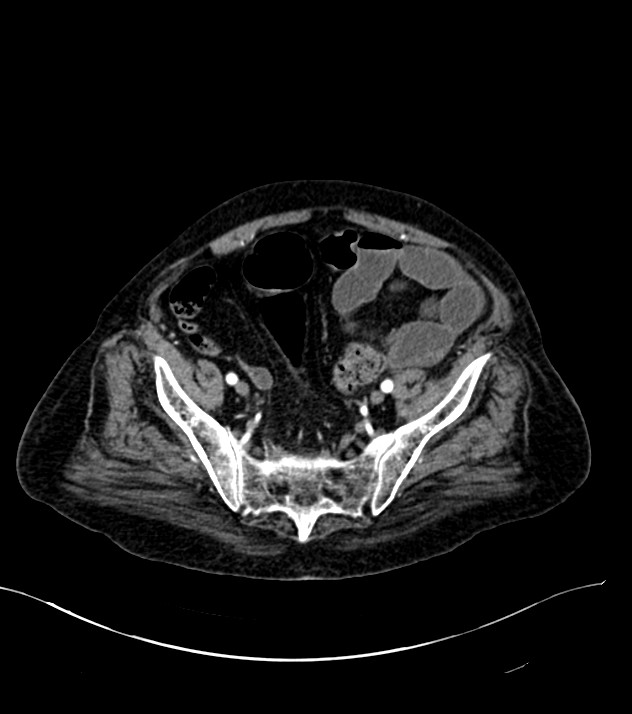 Cholangiocarcinoma with cerebral metastases (Radiopaedia 83519-98629 B 99).jpg