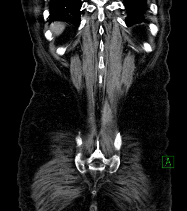 Cholangiocarcinoma with cerebral metastases (Radiopaedia 83519-98629 E 78).jpg