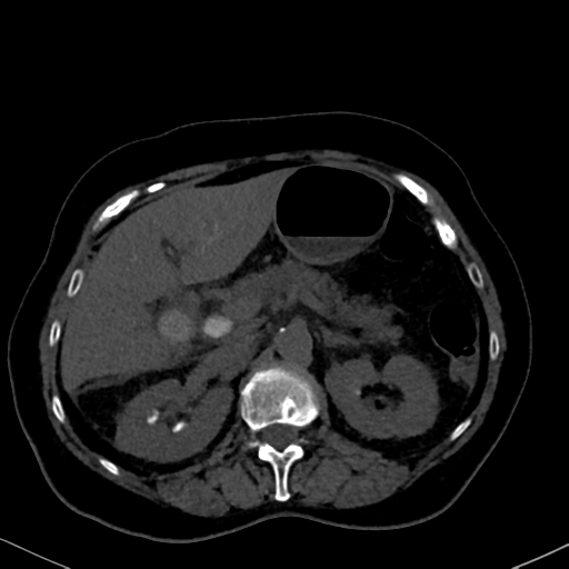 File:Cholecystitis - obstructive choledocholitiasis (CT intravenous cholangiography) (Radiopaedia 43966-47479 Axial 86).png