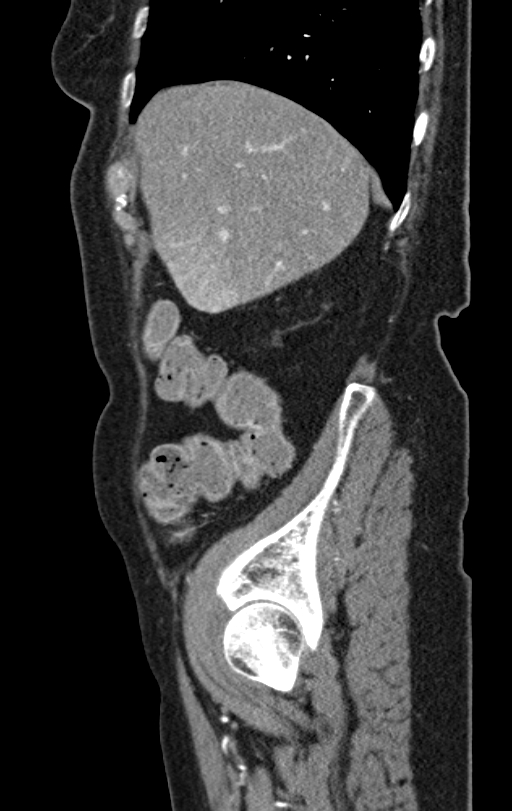Cholecystoduodenal fistula due to calculous cholecystitis with gallstone migration (Radiopaedia 86875-103077 C 50).jpg