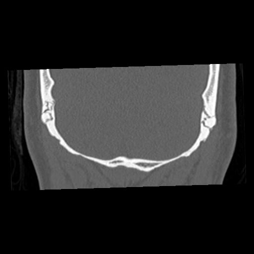 Cholesteatoma (Radiopaedia 84960-100474 Coronal bone window 73).jpg