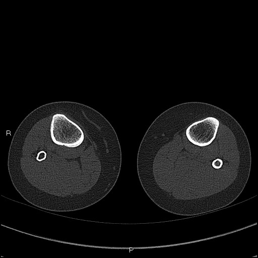 Chondroblastoma (Radiopaedia 62721-71030 Axial bone window 108).jpg