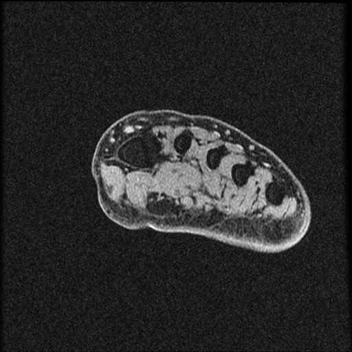File:Chondroblastoma - midfoot (Radiopaedia 64831-73765 F 26).jpg
