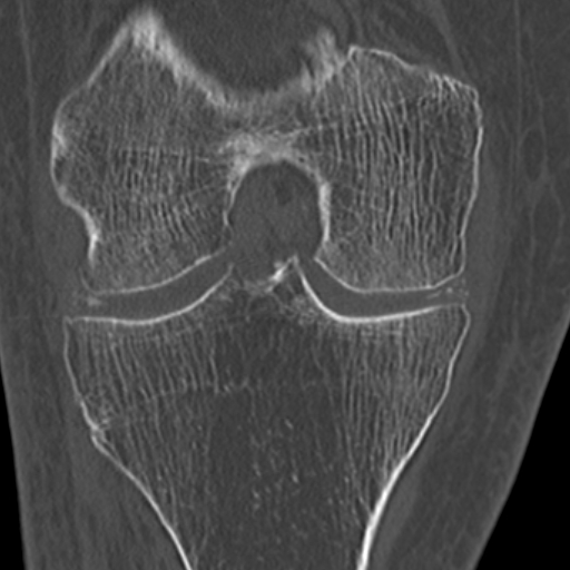 Chondrocalcinosis (Radiopaedia 16275-15955 Coronal bone window 33).jpg