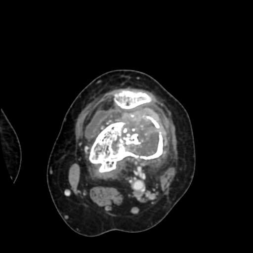 Chondrosarcoma - femur (Radiopaedia 64187-72954 Axial with contrast 37).jpg