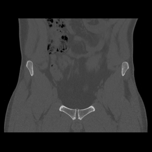 Chondrosarcoma of iliac wing (Radiopaedia 63861-72599 Coronal bone window 34).jpg