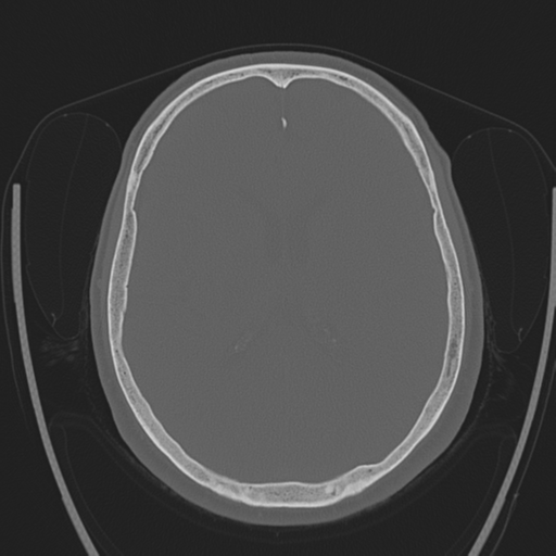Chondrosarcoma of skull base- grade II (Radiopaedia 40948-43653 Axial bone window 28).png